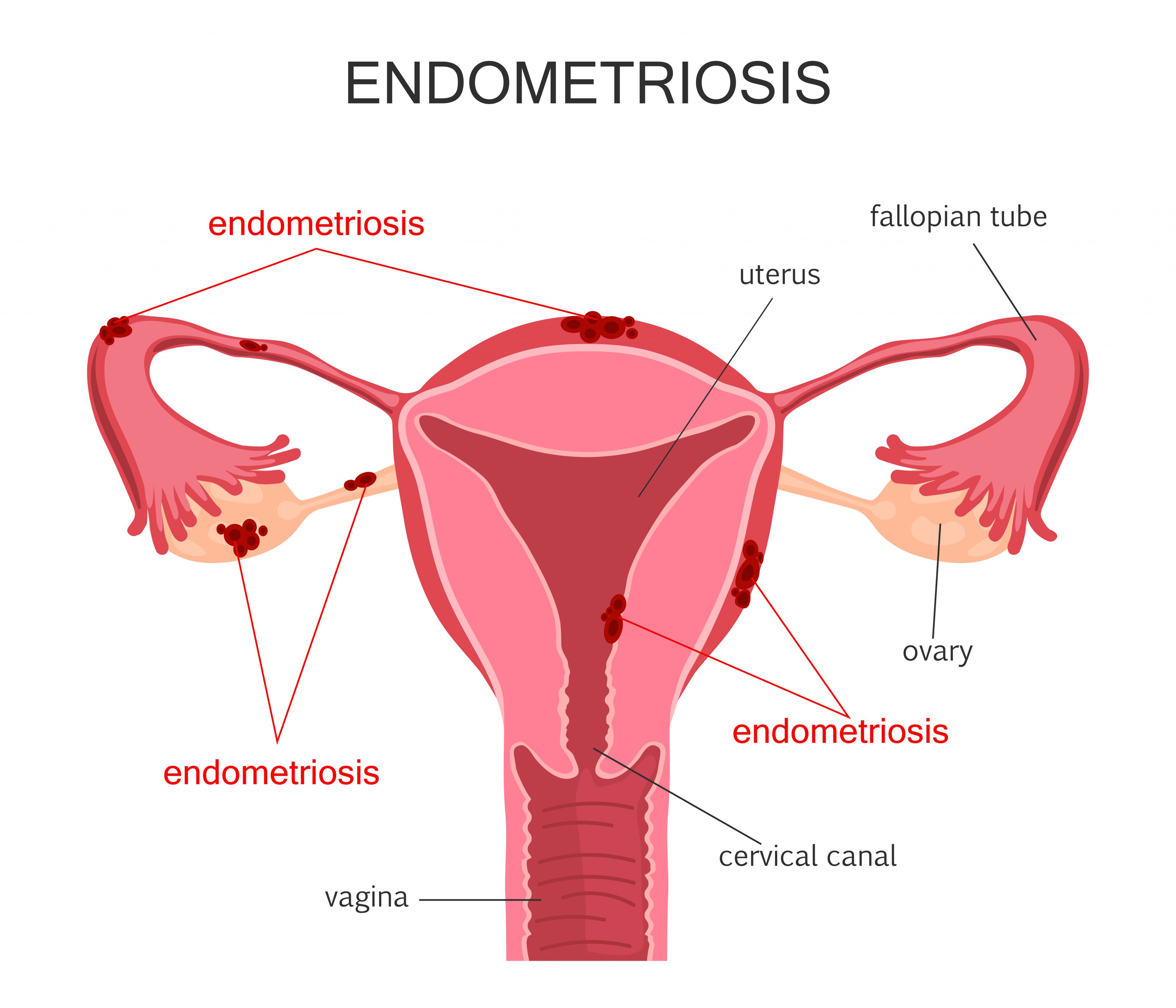 Endometriosis: A painful yet treatable condition for women | MN