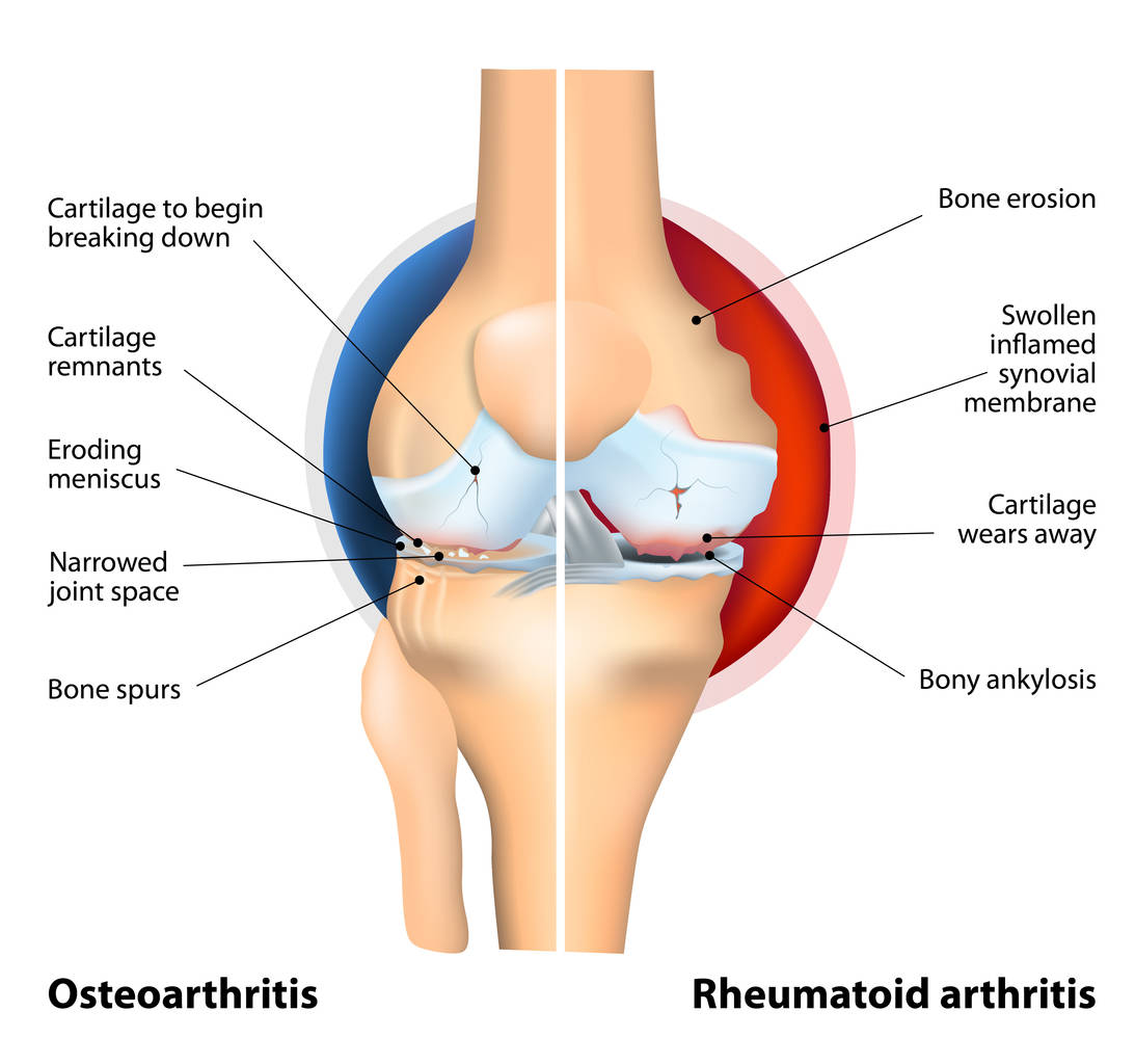 how is arthritis in a cane paratore treated