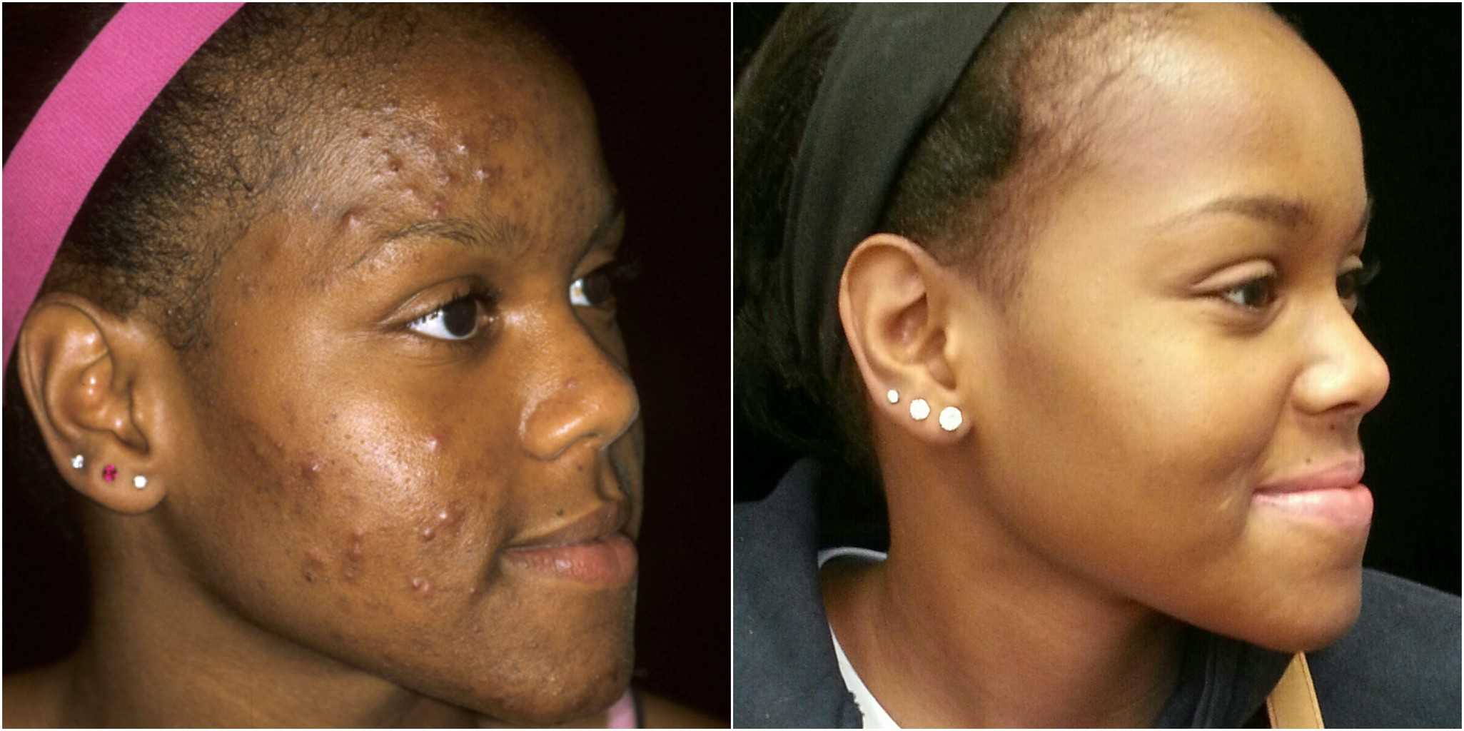 Acne affects all ages and can be treated – MSR News Online