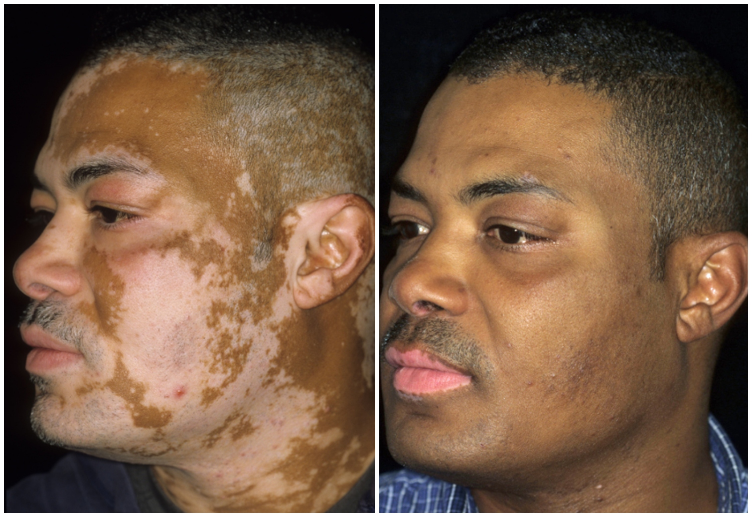 New treatments for vitiligo offer new hope – Minnesota Spokesman-Recorder